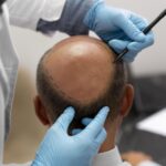 Hair Transplant: The Ultimate Guide to Hair Growth Surgery for Natural Results
