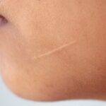 Scar Removal for Hypertrophic Scars: Effective Solutions