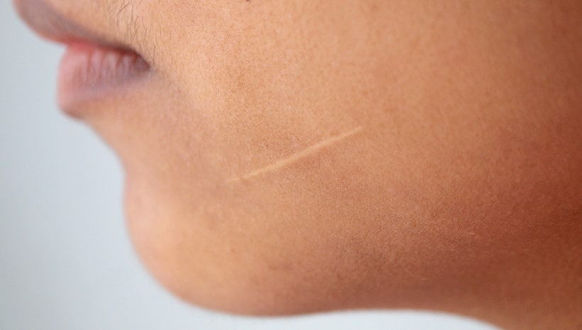 Scar Removal for Hypertrophic Scars: Effective Solutions