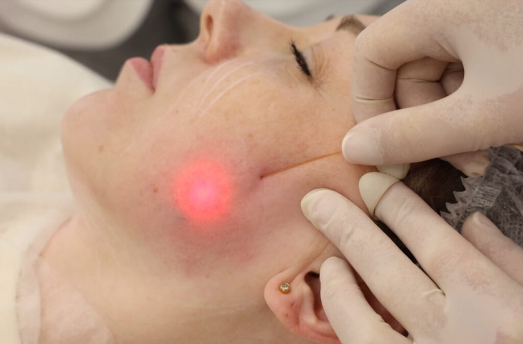 Endolift for Jawline Definition: Dubai’s Sculpting Secret