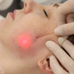 Endolift for Jawline Definition: Dubai’s Sculpting Secret