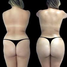 Revision Options for Best Butt fat transfer Surgeons in dubai