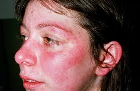 Skin Rash Might Be More Than Just an Allergy , How