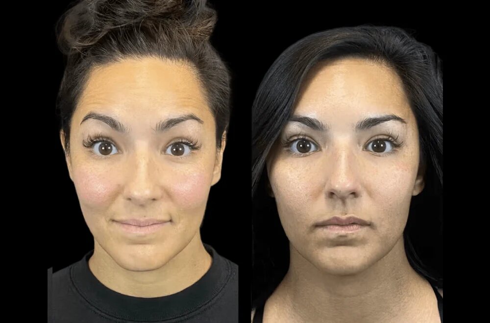 Botox Treatment in Dubai: What Makes It a Global Beauty Hub Favorite