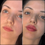 Best Aesthetic Clinic in dubai for Fillers: Choosing the Right Fillers
