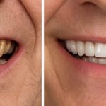 How Can Full Mouth Dental Implants Cost Improve Facial Symmetry Instantly
