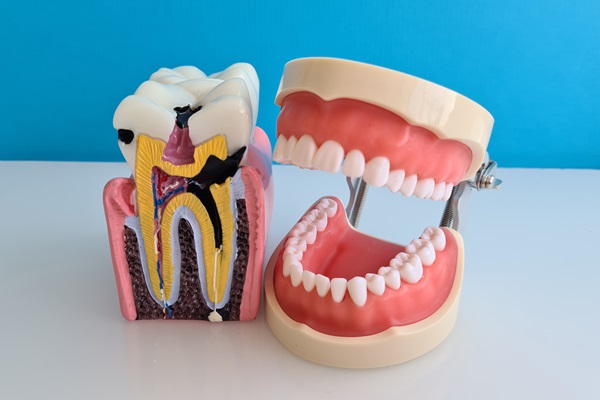 Root Canal Treatment: Common Symptoms Before the Procedure