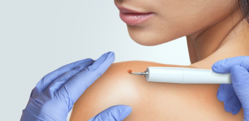 When Should You Seek Professional Treatment for Skin Tag Removal?