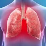 A Complete Guide to Pneumonia in Dubai: Diagnosis, Care, and Recovery