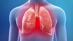 A Complete Guide to Pneumonia in Dubai: Diagnosis, Care, and Recovery