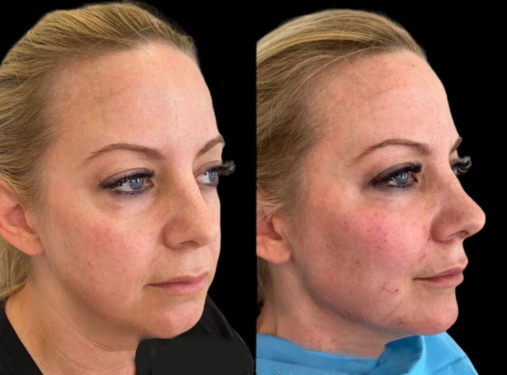 How to Choosing the Right Best Clinic For Cheek Fillers in Dubai