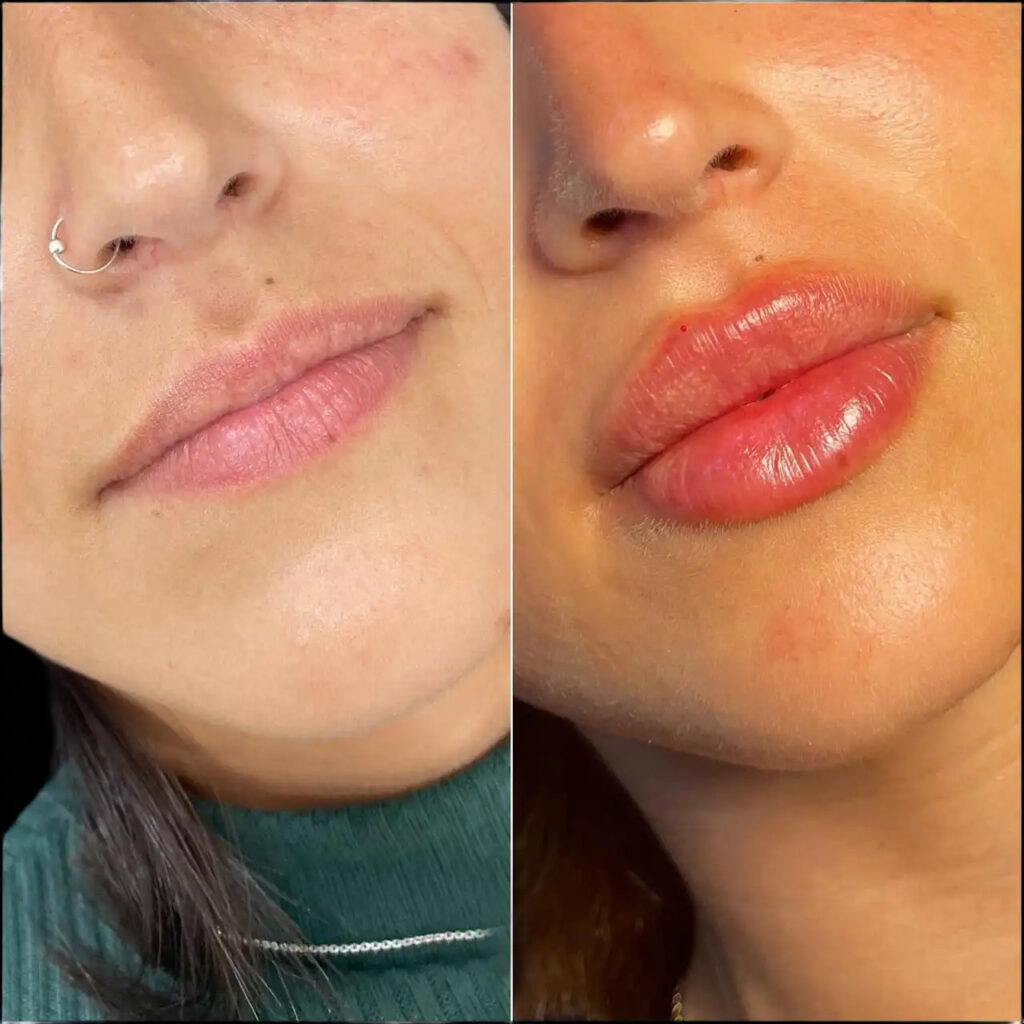 Best Clinics for Dermal Fillers in Dubai What You Need to Know