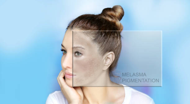 Microneedling for Melasma Treatment in Dubai: Boosting Collagen and Clarity
