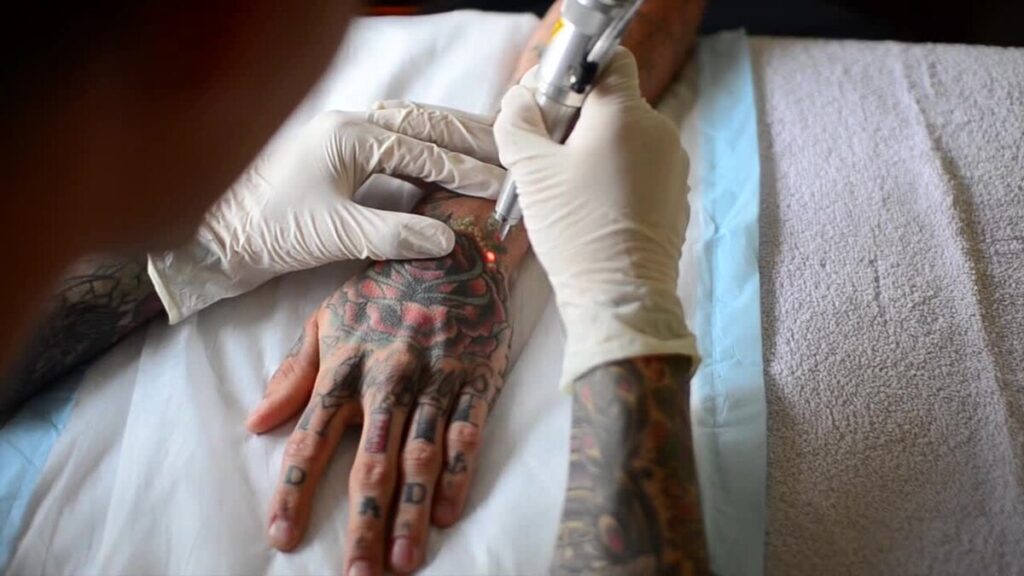 Tattoo Removal Aftercare Products for Dubai’s Hot Weather