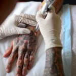 Tattoo Removal Aftercare Products for Dubai’s Hot Weather