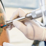 Tattoo Removal in Dubai for Darker Skin Tones