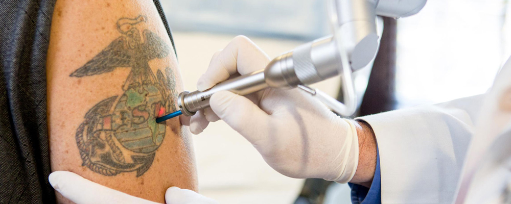 Tattoo Removal in Dubai for Darker Skin Tones