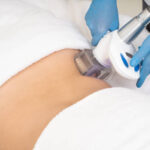 Velashape 3 Treatment in Dubai: Science of Body Sculpting