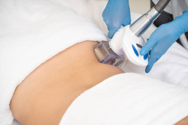 Velashape 3 Treatment in Dubai: Science of Body Sculpting