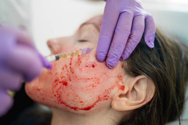 Real Reviews: Microneedling Treatment with PRP in Dubai