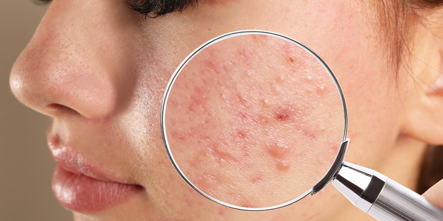 Why Acne Treatment in Riyadh Is Becoming Popular Among Young Adults