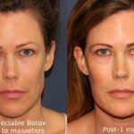Effortless Jawline Botox Before and After: Real Patient Results