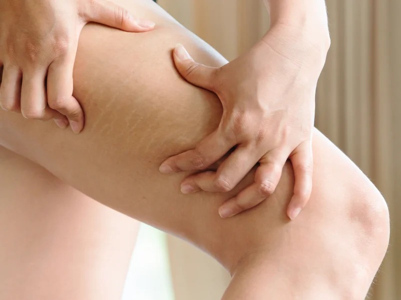 How Does Laser Therapy Improve the Appearance of Stretch Marks?
