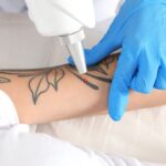 Advanced 2026 Laser Technologies for Tattoo Removal in Dubai