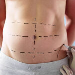 Tummy Tuck in Dubai: Preparing Your Home for Recovery