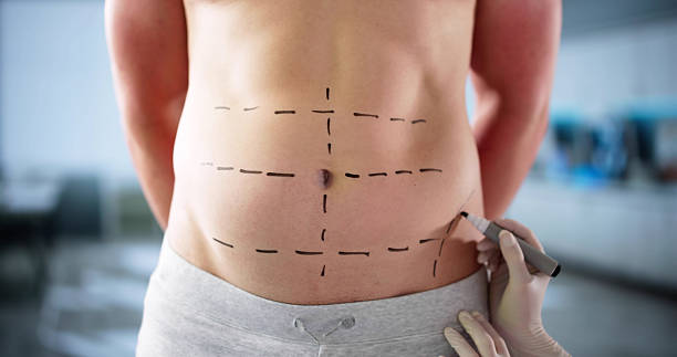 Tummy Tuck in Dubai: Preparing Your Home for Recovery