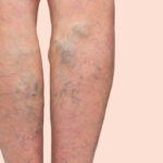 Modern Varicose Veins Treatment in Dubai: Expert Guide