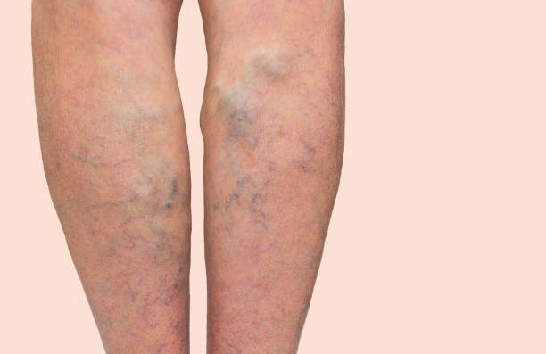Modern Varicose Veins Treatment in Dubai: Expert Guide