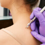 Effective Laser Wart Removal in Dubai for Skin