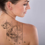 Guide to Tattoo Removal Using Picosure Device in Dubai Clinics