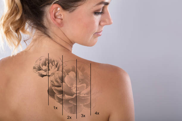 Guide to Tattoo Removal Using Picosure Device in Dubai Clinics