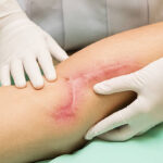 Best Post-Surgical Scar Treatment in Dubai for Results