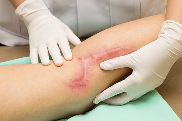 Best Post-Surgical Scar Treatment in Dubai for Results