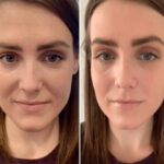 Best Doctors in dubai for PRP Treatment After Hair Transplant