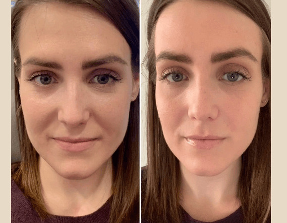 Best Doctors in dubai for PRP Treatment After Hair Transplant