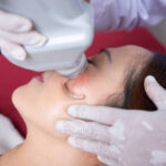 Erase Hyperpigmentation via Pico Laser in Dubai Method