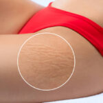 Stretch Mark Removal in Dubai: Advanced Treatment Zones
