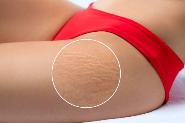 Stretch Mark Removal in Dubai: Advanced Treatment Zones