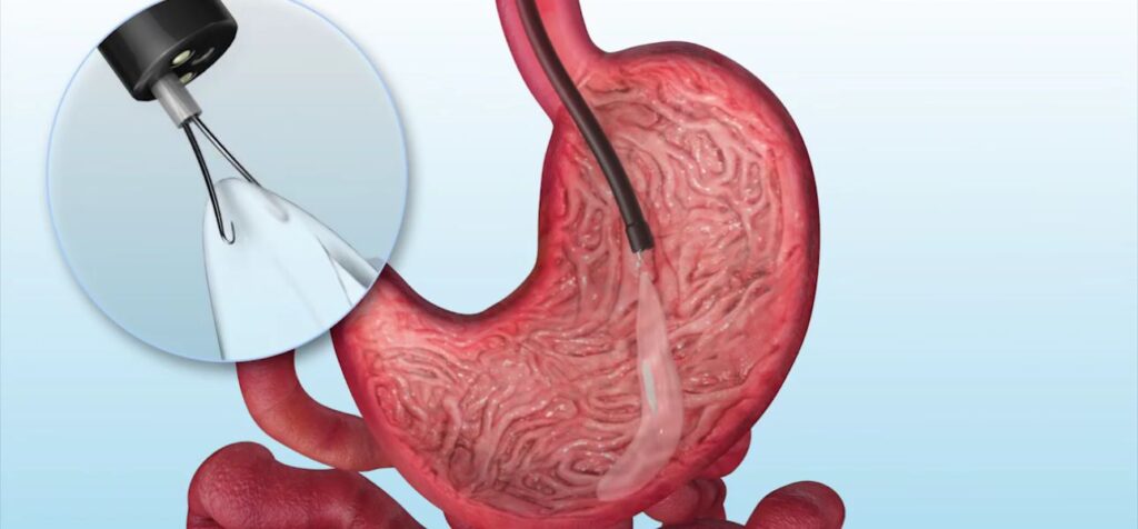 Gastric Balloon Placement: What You Need to Know Today