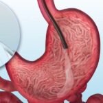 Gastric Balloon Placement: What You Need to Know Today