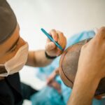 What To Look For While Selecting A Hair Transplant Doctor?