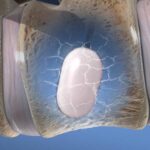 Kyphoplasty Procedure in Plano – A Simple Solution For Spinal Fracture Pain