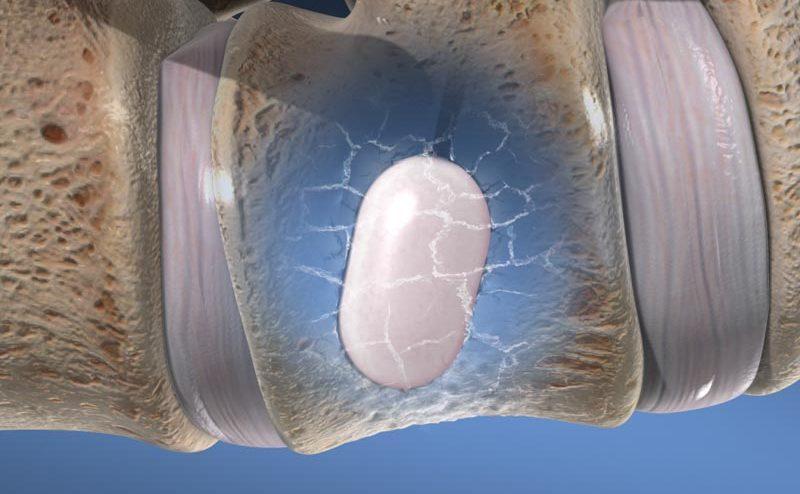 Kyphoplasty Procedure in Plano – A Simple Solution For Spinal Fracture Pain