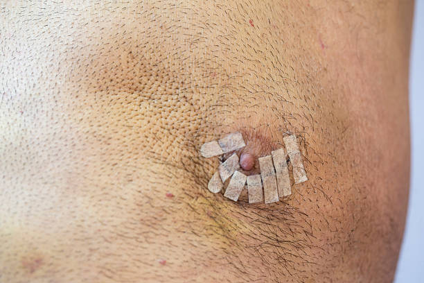 Gynaecomastia Surgery in Dubai: Results and Recovery Insights