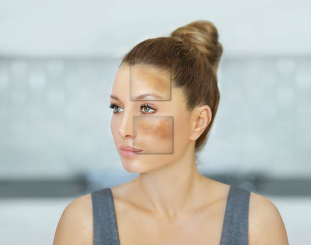 Pigmentation Treatment in Dubai: Clearer Skin Guide