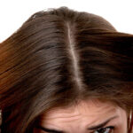 Dandruff Treatment in Dubai: Causes & First Signs